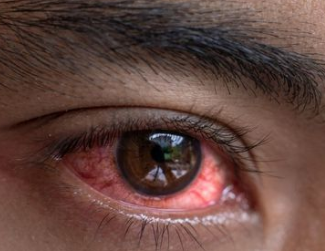 症状:起病急,双眼同时或先后发病,患眼有刺痛,痒,异物感,重者有畏光及