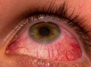 �۾���Ѫ��ԭ��ͼƬ �۾���Ѫ��ô��