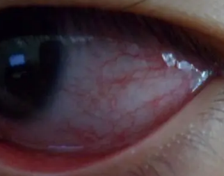 �۾���Ѫ��ԭ��ͼƬ �۾���Ѫ��ô��