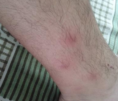 床虱咬过后的疙瘩照片 消灭床虱的方法