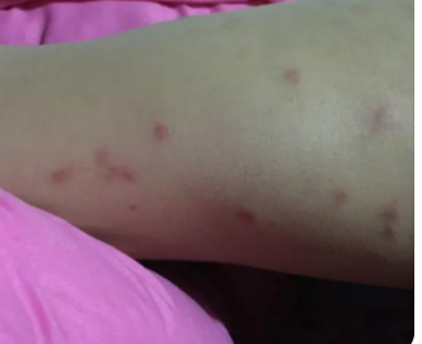 床虱咬过后的疙瘩照片 消灭床虱的方法