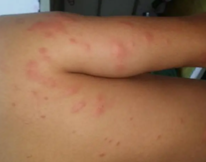 床虱咬过后的疙瘩照片 消灭床虱的方法