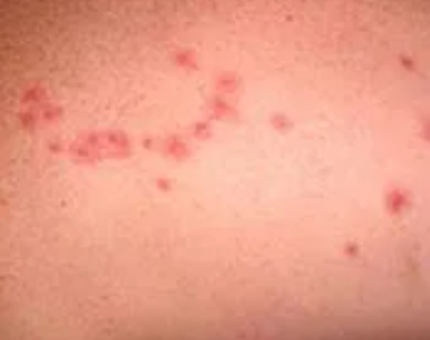 床虱咬过后的疙瘩照片 消灭床虱的方法