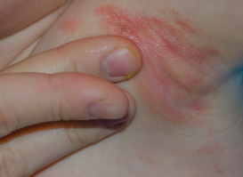 ����˯��Ƥ������ô�� Ƥ��ֹ�������������