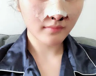 隆鼻恢复过程图片一周 7天内的恢复还是很不明显