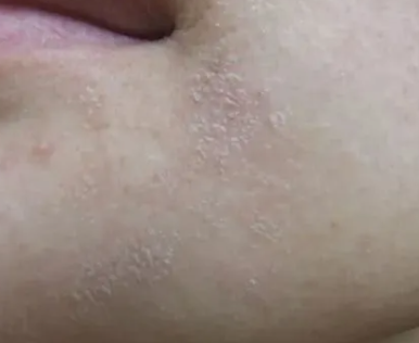 皮肤干燥起皮怎么办 脸部皮肤干燥起皮发红刺痛怎么办