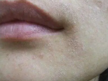 皮肤干燥起皮怎么办 脸部皮肤干燥起皮发红刺痛怎么办