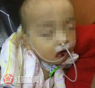 男童误把火碱吃下 奶奶喂水冲洗导致严重烧伤