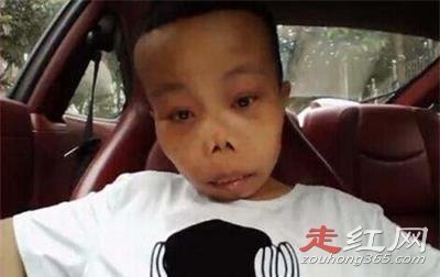 ��ɽȥ�������� ���к�ƶѪ֢��û����ô����