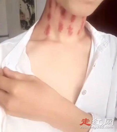 锁骨种草莓的危害安全吗会死吗对身体不好吗