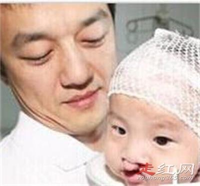 李亚鹏王菲女儿李嫣然唇腭裂照片为什么会先天兔唇