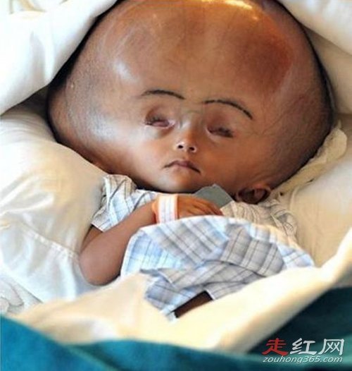 罗娜·贝古姆治好了吗 现状如何几岁了