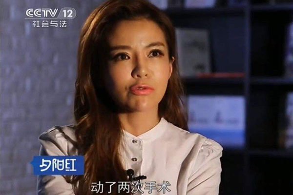 朱迅脖子上有疤痕吗患上了甲状腺癌住院手术